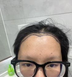 -大麦微针植发全国连锁