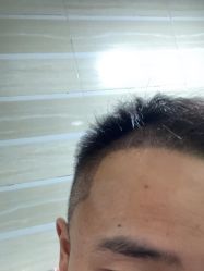 体验后-大麦微针植发全国连锁