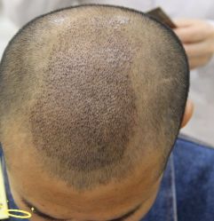 -大麦微针植发丨全国连锁