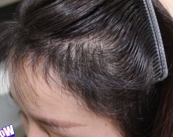 -大麦微针植发丨全国连锁