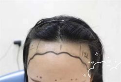-大麦微针植发全国连锁