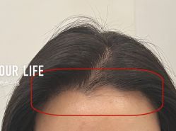 -大麦微针植发全国连锁