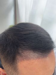 -大麦微针植发丨全国连锁