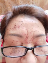 体验后-美丽人生祛斑扁平疣汗管瘤中心