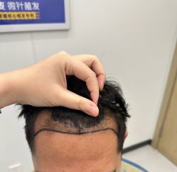 -大麦微针植发全国连锁