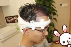 -大麦微针植发丨全国连锁