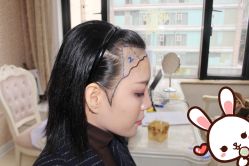 -大麦微针植发丨全国连锁