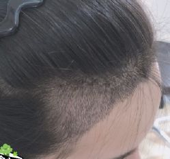 -大麦微针植发丨全国连锁