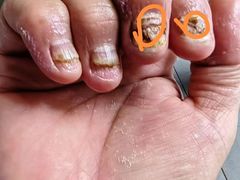 -祖传修脚甲沟炎灰指甲鸡眼