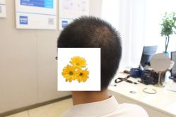 -大麦微针植发丨全国连锁