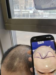 -碧莲盛·不剃发植发