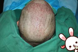 点击看大图 -大麦微针植发丨全国连锁