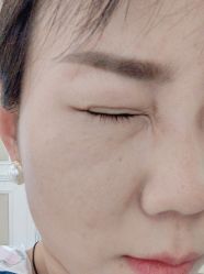 体验后-海涛医疗美容·面部抗衰·注射美鼻