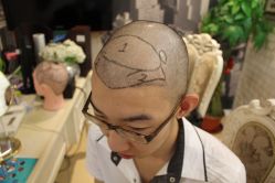 点击看大图 -大麦微针植发丨全国连锁