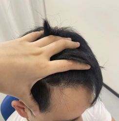 -大麦微针植发全国连锁