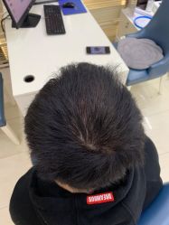 -大麦微针植发丨全国连锁