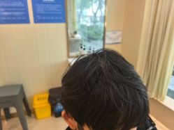 -碧莲盛·不剃发植发