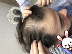 -大麦微针植发丨全国连锁