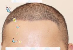 -大麦微针植发全国连锁