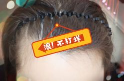 -大麦微针植发全国连锁