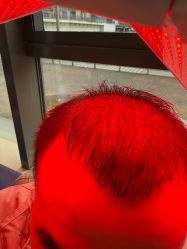 -碧莲盛·不剃发植发