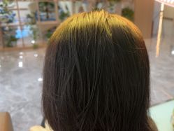 -碧莲盛·不剃发植发