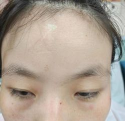 体验后-北京美痣堂古方祛痣斑疣瘊