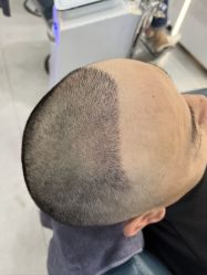 体验后-大麦微针植发全国连锁