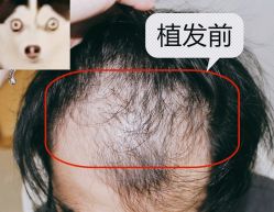 -大麦微针植发全国连锁