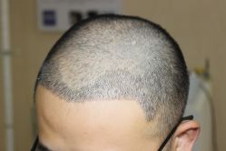 -大麦微针植发丨全国连锁