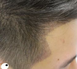 -大麦微针植发丨全国连锁