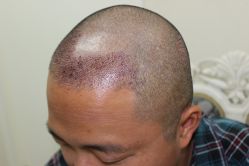 点击看大图 -大麦微针植发丨全国连锁