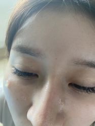 -爱莎扁平疣·汗管瘤·斑痣中心