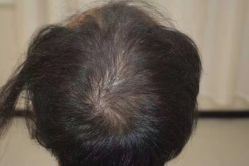 -大麦微针植发全国连锁