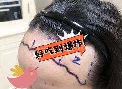 -大麦微针植发全国连锁