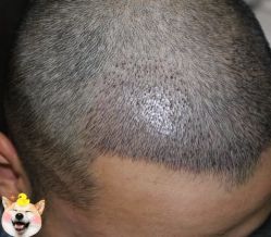 -大麦微针植发丨全国连锁