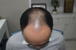 -大麦微针植发全国连锁