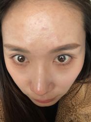 体验后-宥莉·ULLY 痘敏肌•科技皮肤管理中心