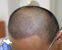 -大麦微针植发丨全国连锁