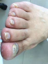 -德哥灰指甲脚气甲沟炎跖疣护理