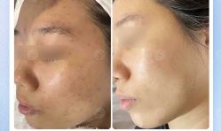 -美肤盾祛痘·问题肌头疗管理中心