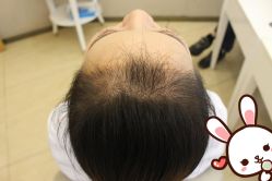 点击看大图 -大麦微针植发丨全国连锁