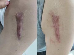 -杭州仁易堂中医康复医院疤痕修复