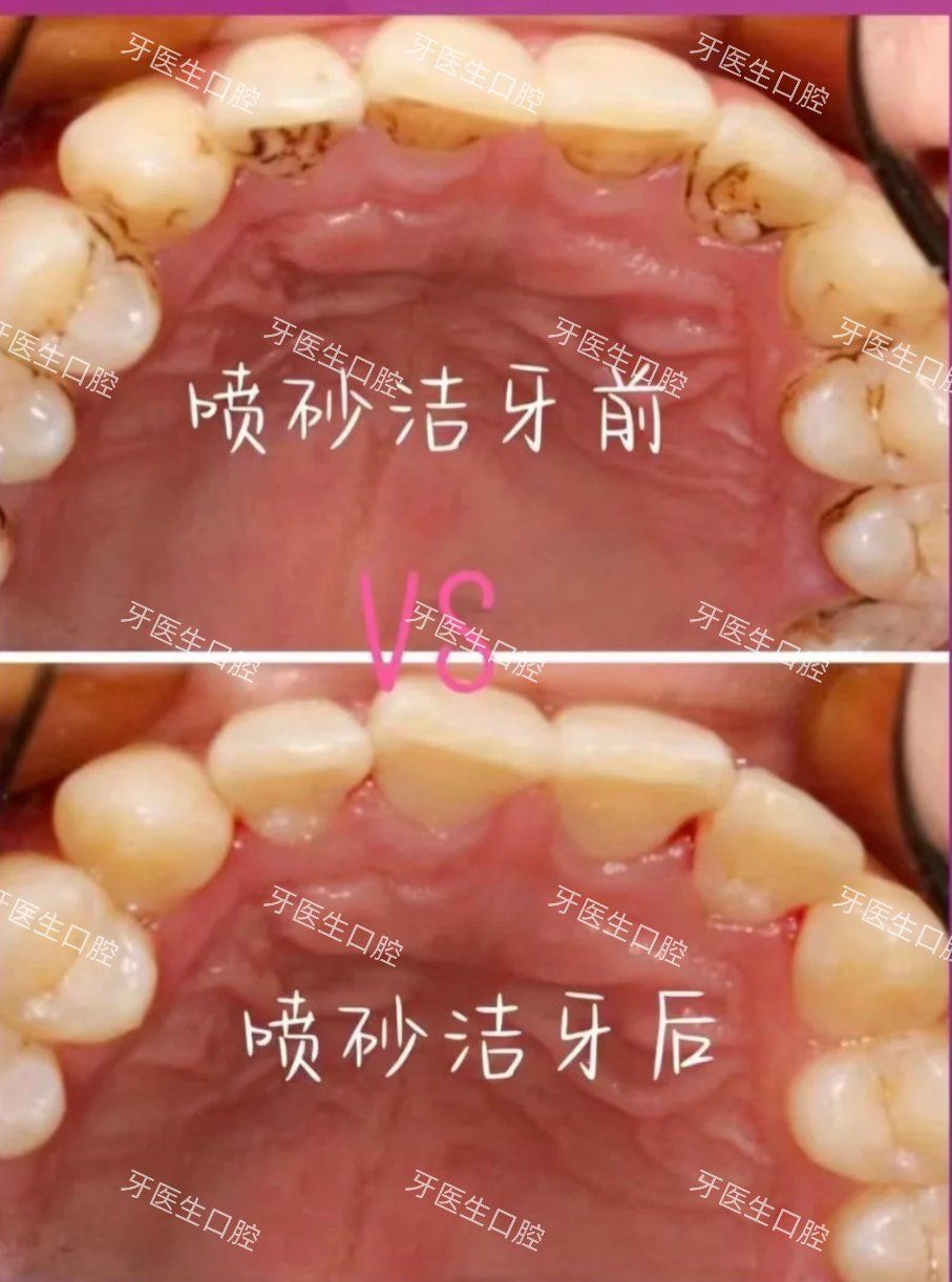 喷砂洗牙,烟渍茶渍的克星