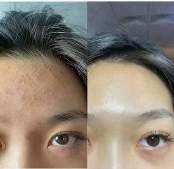 -瑶芳清颜草本祛痘