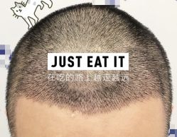 -大麦微针植发全国连锁