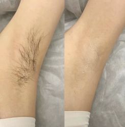 -薇兰专业脱毛连锁机构