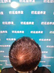 -碧莲盛·不剃发植发