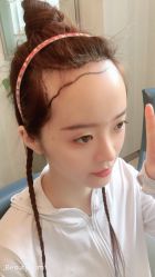 -大麦微针植发丨全国连锁