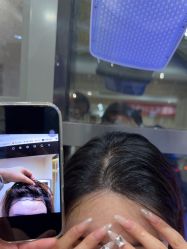 -碧莲盛·不剃发植发